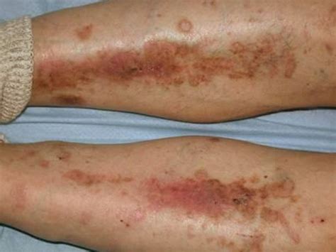 diabetic dry skin  legs pictures  symptoms  pictures