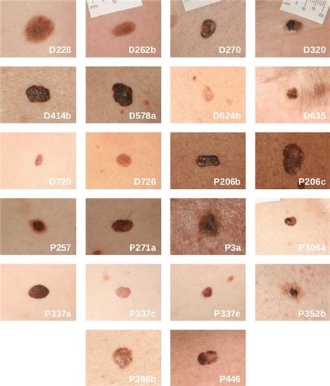 skin lesion images    analysis   performed  scientific diagram