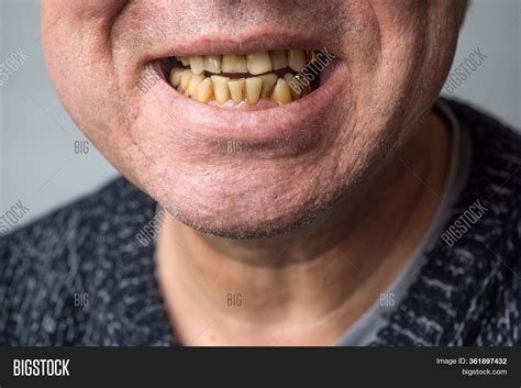 yellow rotten teeth image photo  trial bigstock
