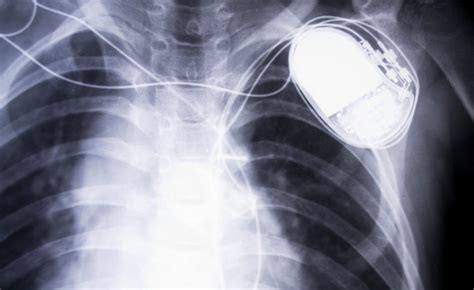avalus surgical aortic valve receives fda and european commission