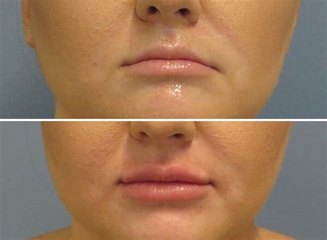 juvederm lip augmentation before after pictures dr kitto