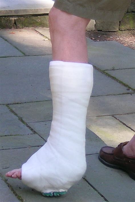 fileshort leg walking castjpg wikimedia commons