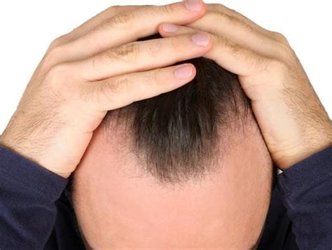 receding hairline now a drug promises to cure baldness health