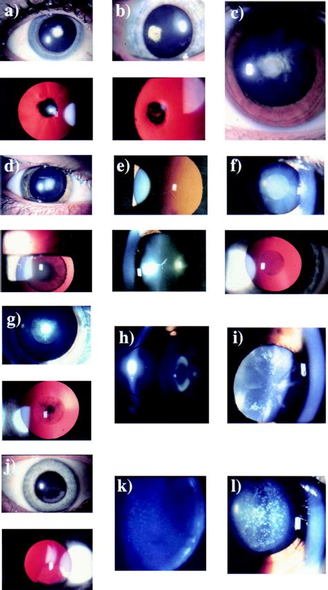 clinical and genetic heterogeneity in autosomal dominant cataract