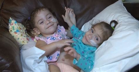 Conjoined Twins Recovering After Successful Separation Surgery