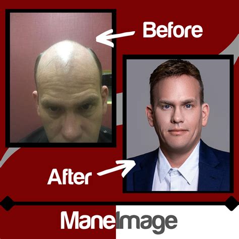 difference   hair systems    men