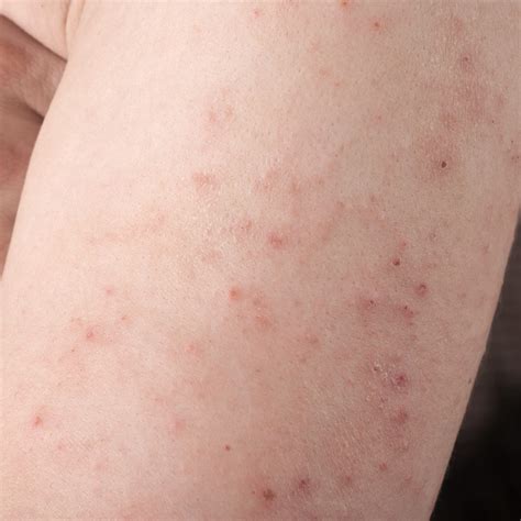 dermatitis herpetiformis  itchy burning blistering rash