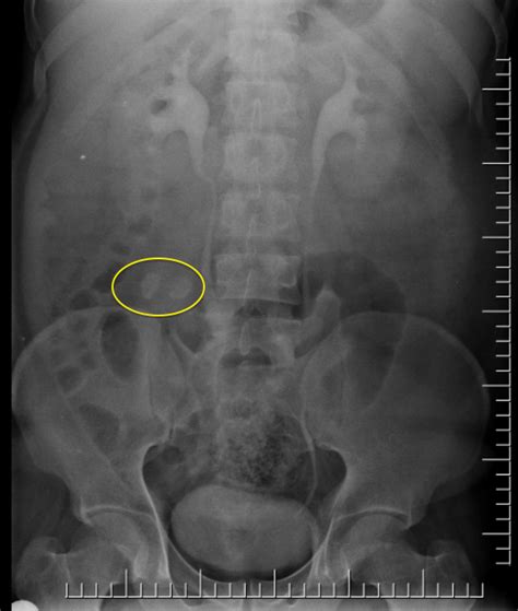 Calcified Intra Abdominal Lymph Nodes Image