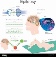 Bildergebnis für Epilepsie durch Hippokampussklerose. Größe: 181 x 185. Quelle: fity.club