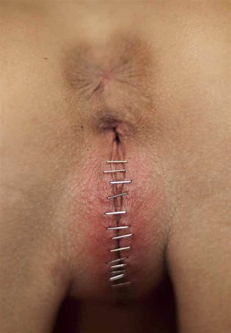 girl with pussy sewn shut