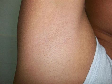 file armpit of a teenager in developement mar 2013 wikimedia commons