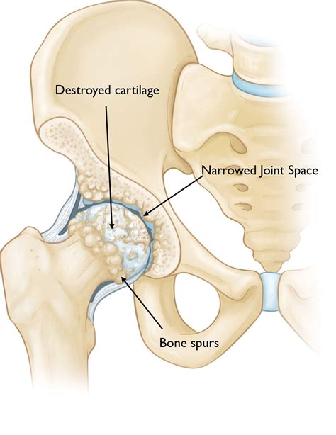 hip osteoarthritis orthoinfo aaos