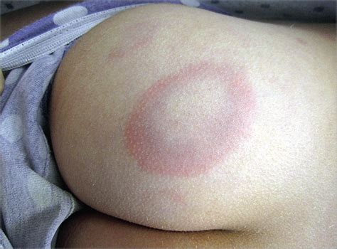 pink violaceous patches on the lower back buttocks and thighs of a 13