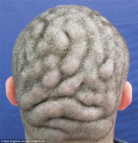 man suffers bizarre  rare medical condition    scalp    twisted