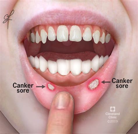 Canker Sore Aphthous Ulcer What It Is Causes And Treatment