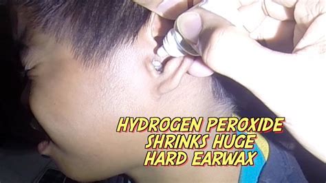 hydrogen peroxide shrinks huge hard earwax youtube