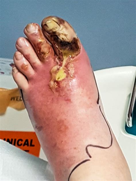 Man S Toe Exploded When He Stubbed It Metro News