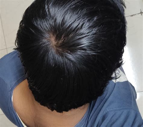 normal hair whorl     onset  balding     thin hair