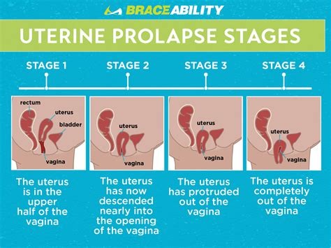 [31 ] Uterine Prolapse Stages Treatment