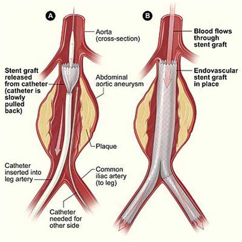 stent aneurisma aortico esquema cardiacosnet