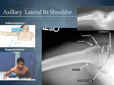 shoulder lateral  ray polymed lab