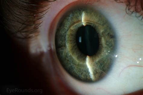 Verisyse Phakic Intraocular Lens Implant For High Myopia