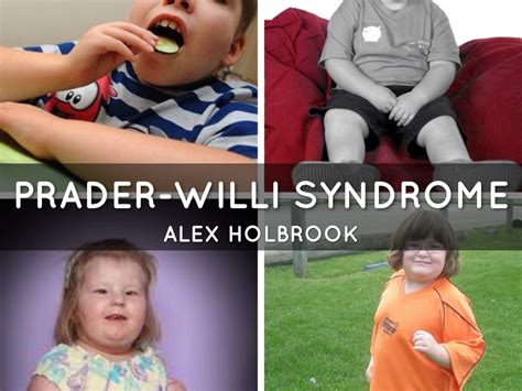 Prader Willi Syndrome By Alexander Holbrook
