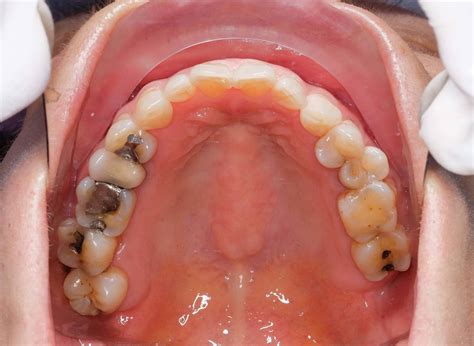 dental amalgam   phased  european parliament agrees dentistrycouk