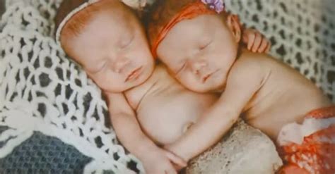 rare twins were born at just 33 weeks but when doctors noticed their
