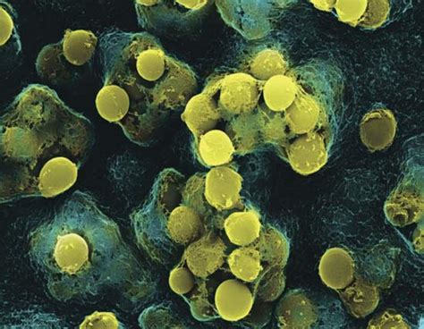 year  boy dies  bacteria   strep throat