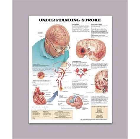 anatomical chart  understanding stroke sports supports mobility