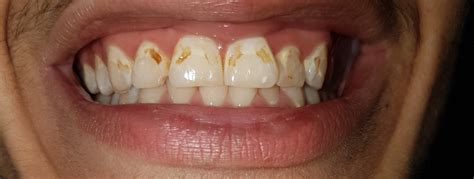bruine aanslag op tanden behandeling tandartsnl forum