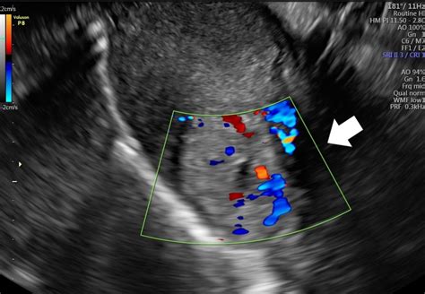 cureus interstitial pregnancy case report  atypical ectopic pregnancy