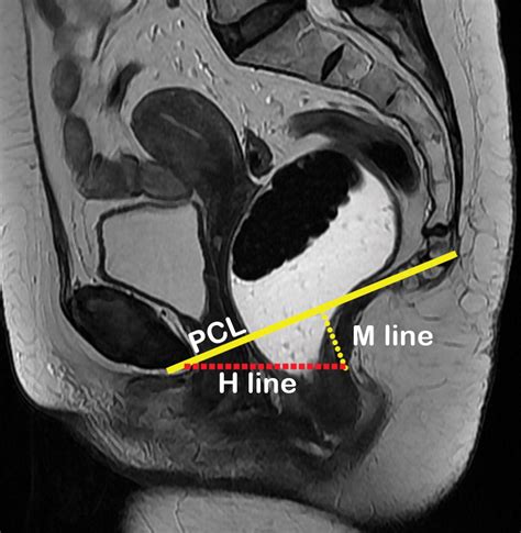 mr imaging based assessment of the female pelvic floor radiographics