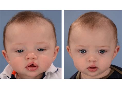cleft lip     dallas pediatric plastic surgeon