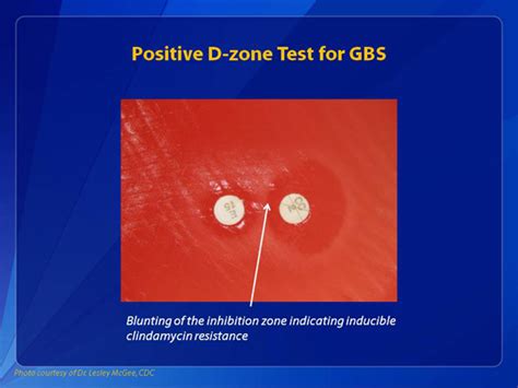 Gbs Lab Prevention Guidelines And Resources Group B