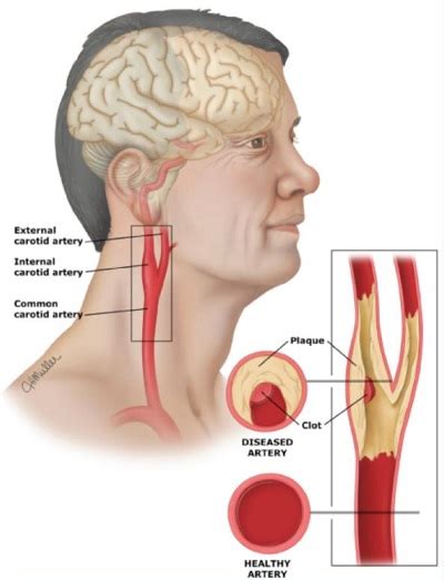 Carotid Arteries Disease Ashchi Heart And Vascular Center