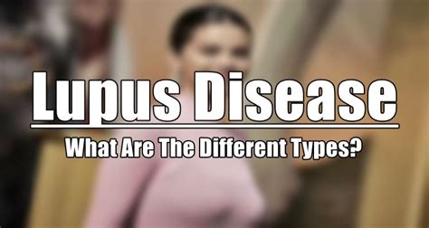 lupus disease     types   disease