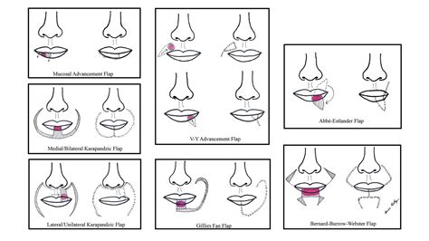 lip reconstruction  mohs micrographic surgery  guide  flaps