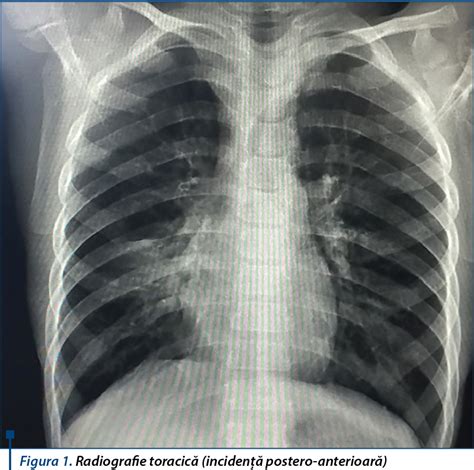 sindromul de lob mijlociu în alergia respiratorie prezentare de caz
