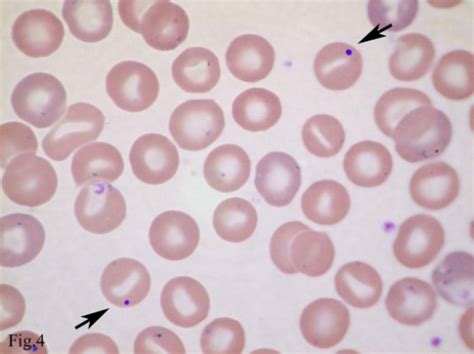 anemia hemolitik ~ informasi kedokteran dan kesehatan