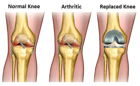 common questions about knee replacement surgery orthopedic center for