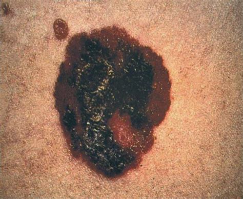 health  trusted sources skin cancer melanoma