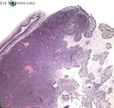 Retinoblastoma Pathology Online Atlas Of Ophthalmology