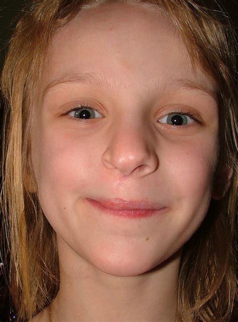 file year  girl showing scar  infantile facial reconstruction