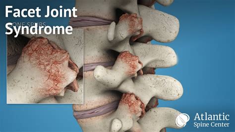facet joint syndrome carolina regional orthopedics