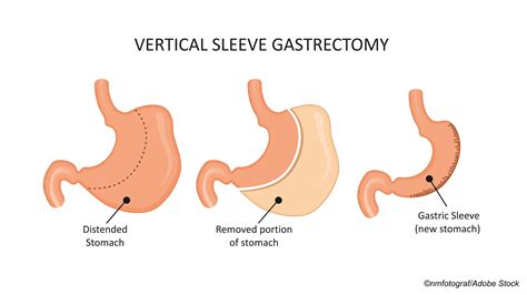 sleeve gastrectomy safer  gastric bypass   years     physicians weekly