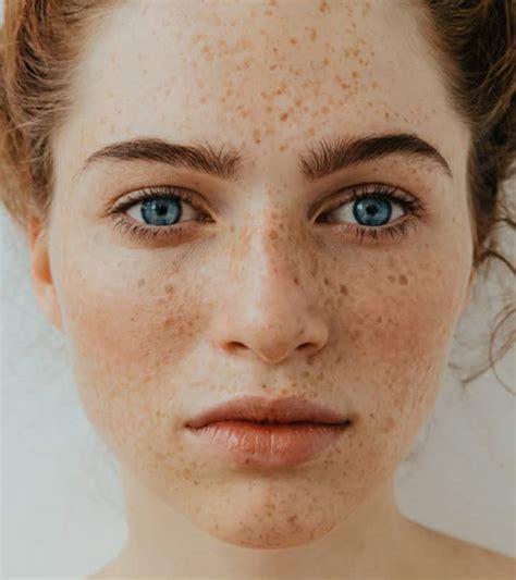 home remedies  freckles  face  prevention tips