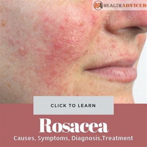 rosacea causes picture symptoms and treatment