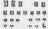 Karyotype Human Chromosomes Homologous Chromosome Normal Karyotypes Denver Syndrome Biology System 46 Hunter Worksheet Pairing Cell Pairs Definition Genes Female sketch template